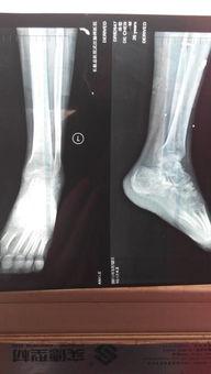 脚骨折走路视频,视频解析骨折后走路技巧